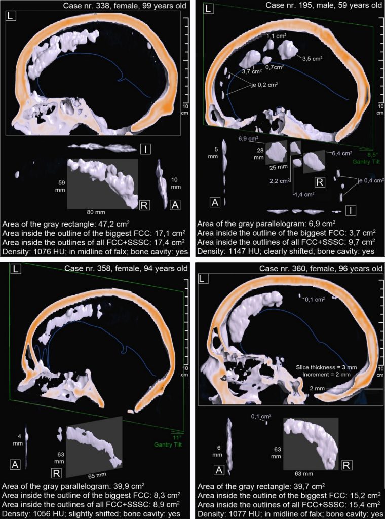 Falx cerebri Calcifications and Ossifications in CT Scans