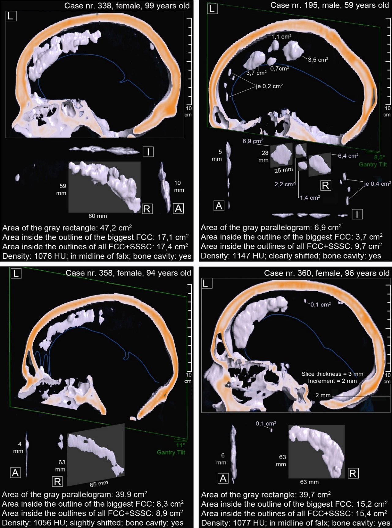 Falx cerebri Calcifications and Ossifications in CT Scans - A Data ...